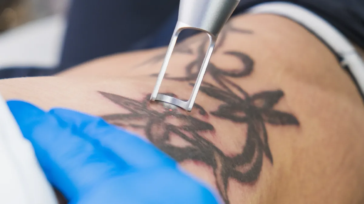 “Say Goodbye to Unwanted Ink – Advanced Tattoo Removal Solutions!”