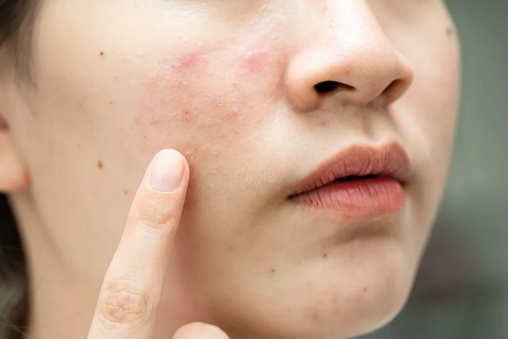 Acne scar treatment