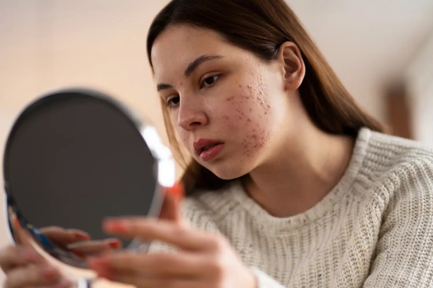 best acne treatment