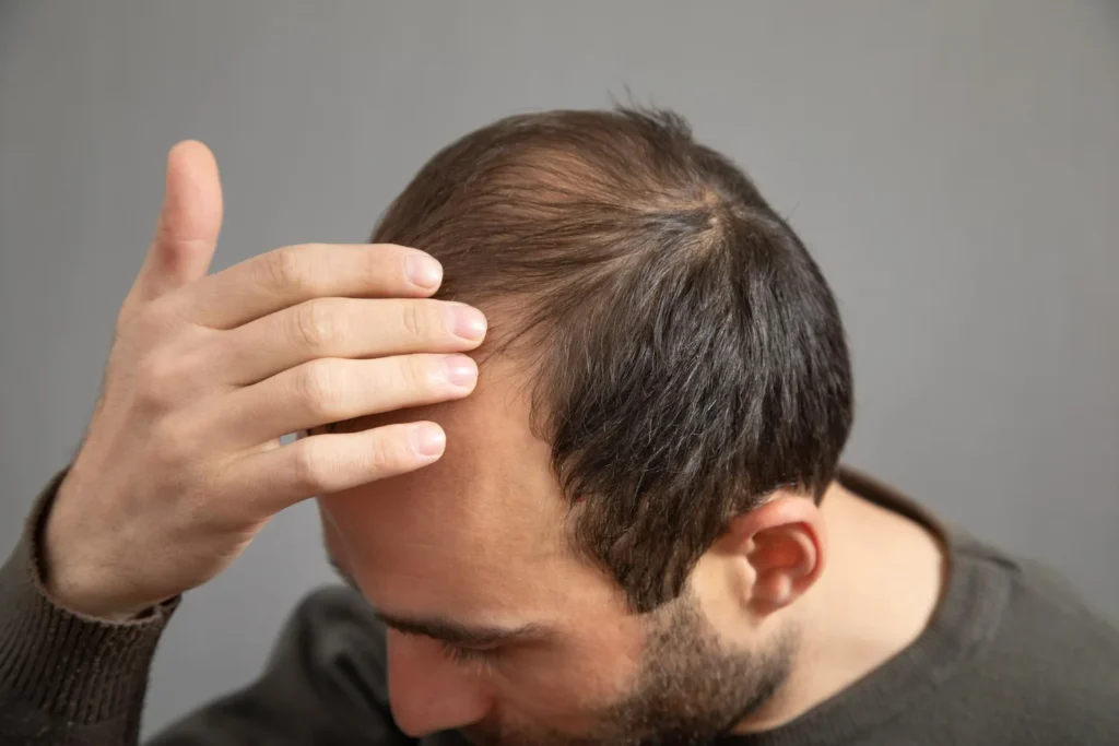hair transplant in Bilaspur
