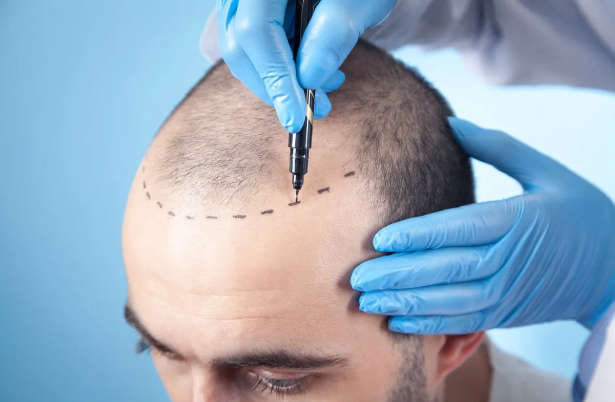 Hair Transplant in Chhattisgarh: Expert Advice to Regain Your Confidence Naturally