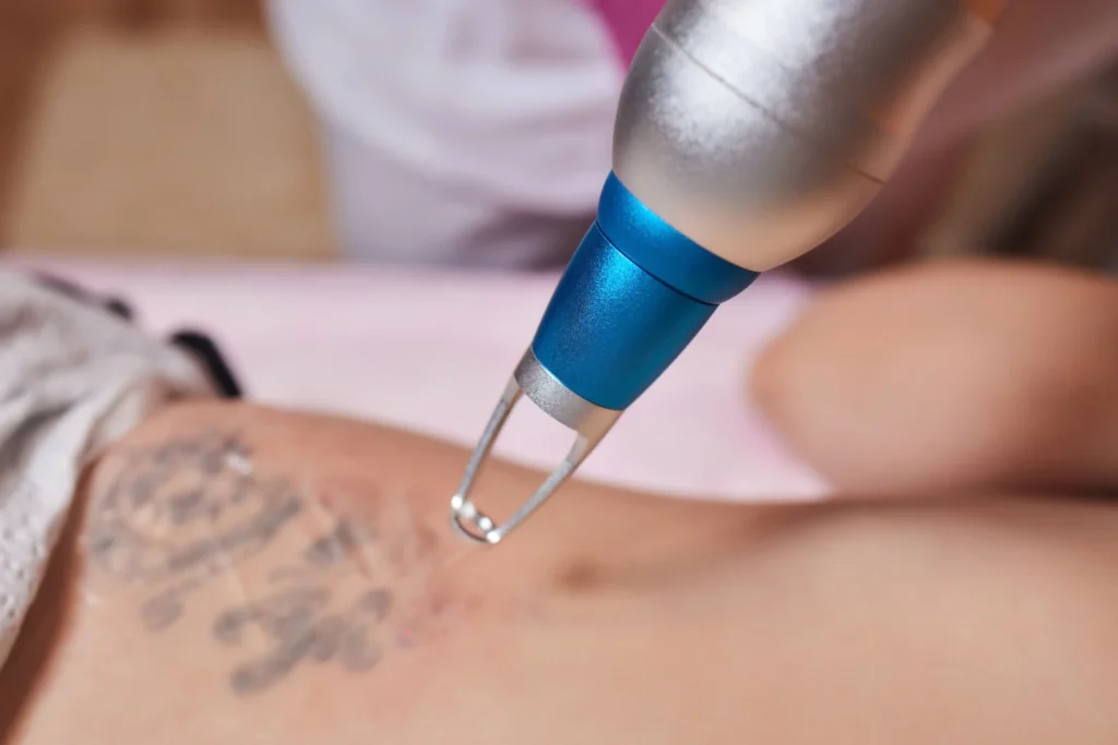 tattoo removal in Bilaspur