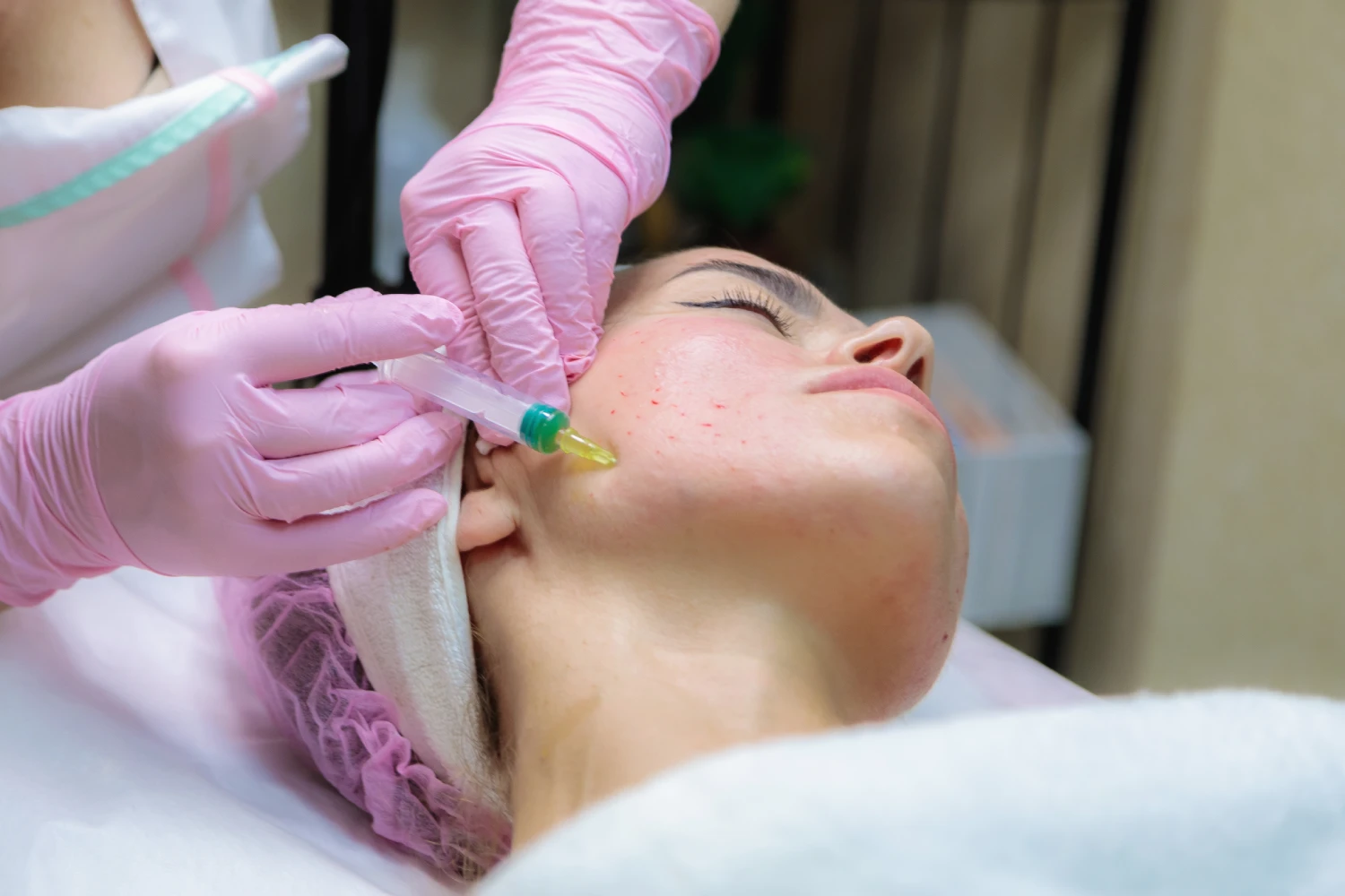 Bilaspur acne treatment